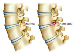 Herniated Discs