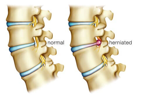 Herniated Discs