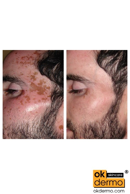 Benoquin Monobenzone 20% Cream