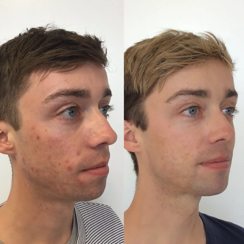 Tretinoin Gel